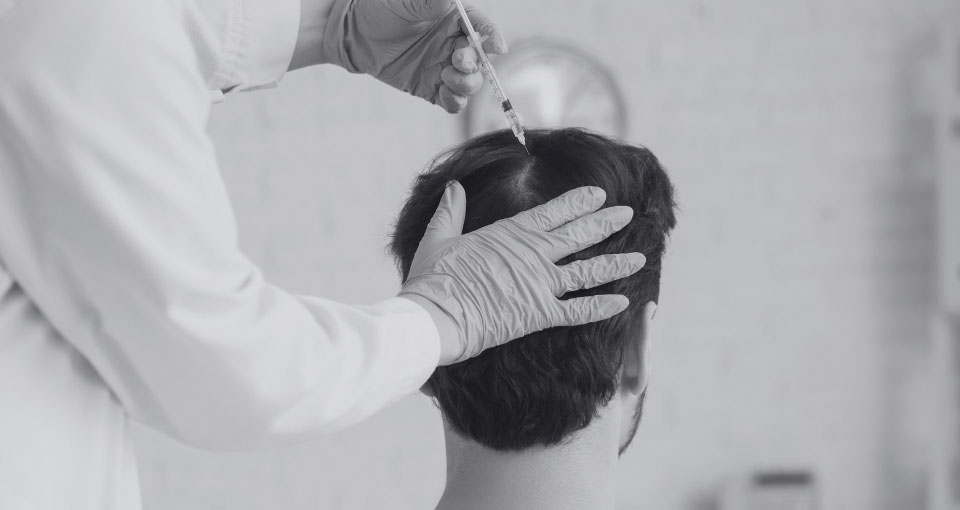 Mesoterapia capilar